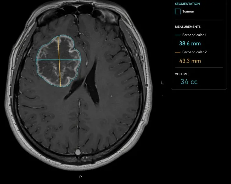 Brain tumour segmentation with perpendicular bidimensional measurements and volume